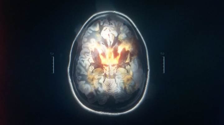 Alzheimer’s Research UK, brain scan