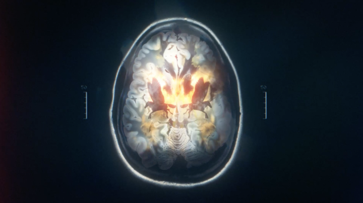 Alzheimer’s Research UK, brain scan